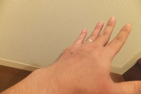 骨折完治!