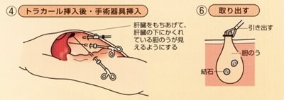 入院生活その５ 手術編