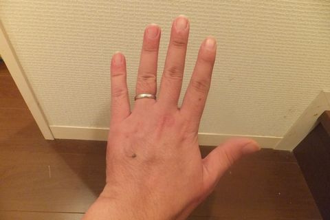 骨折完治！