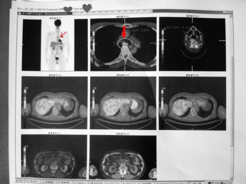 今年の初検査と・・PETCTの結果